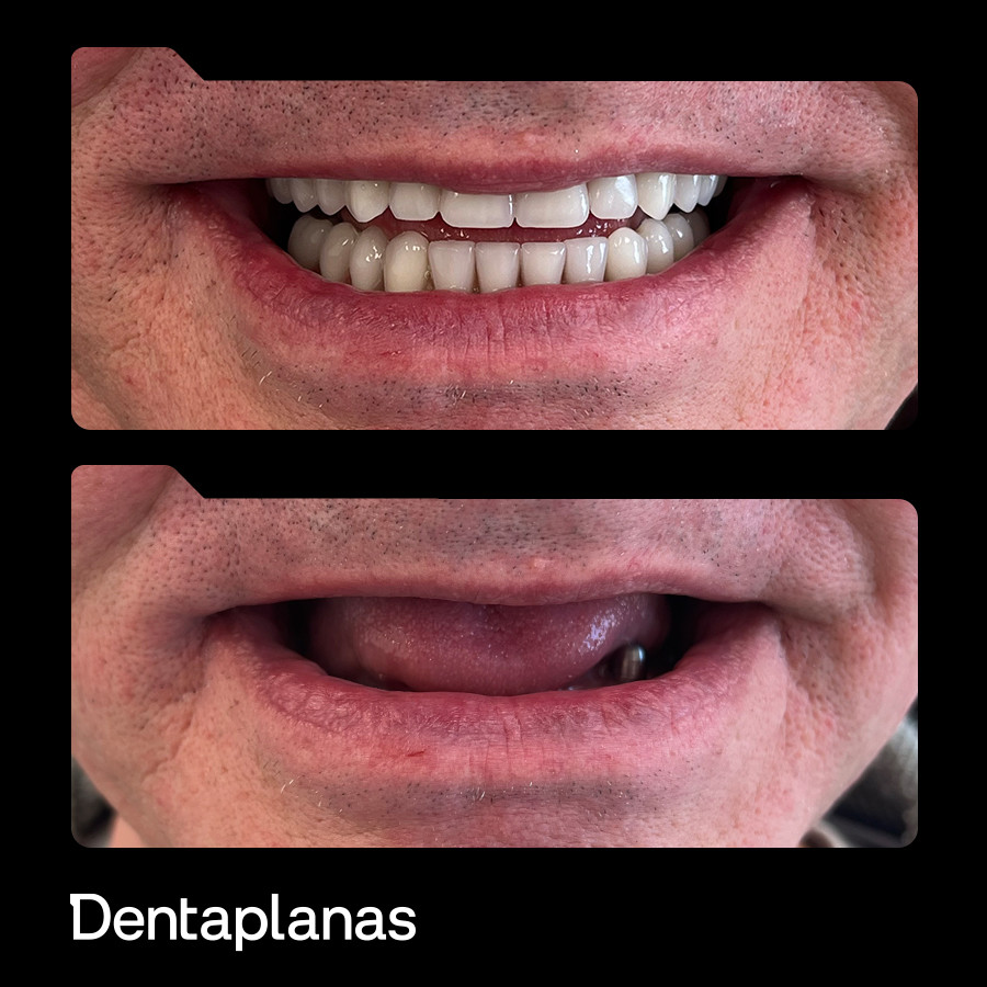 Dentaplanas