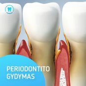 Periodontito gydymas